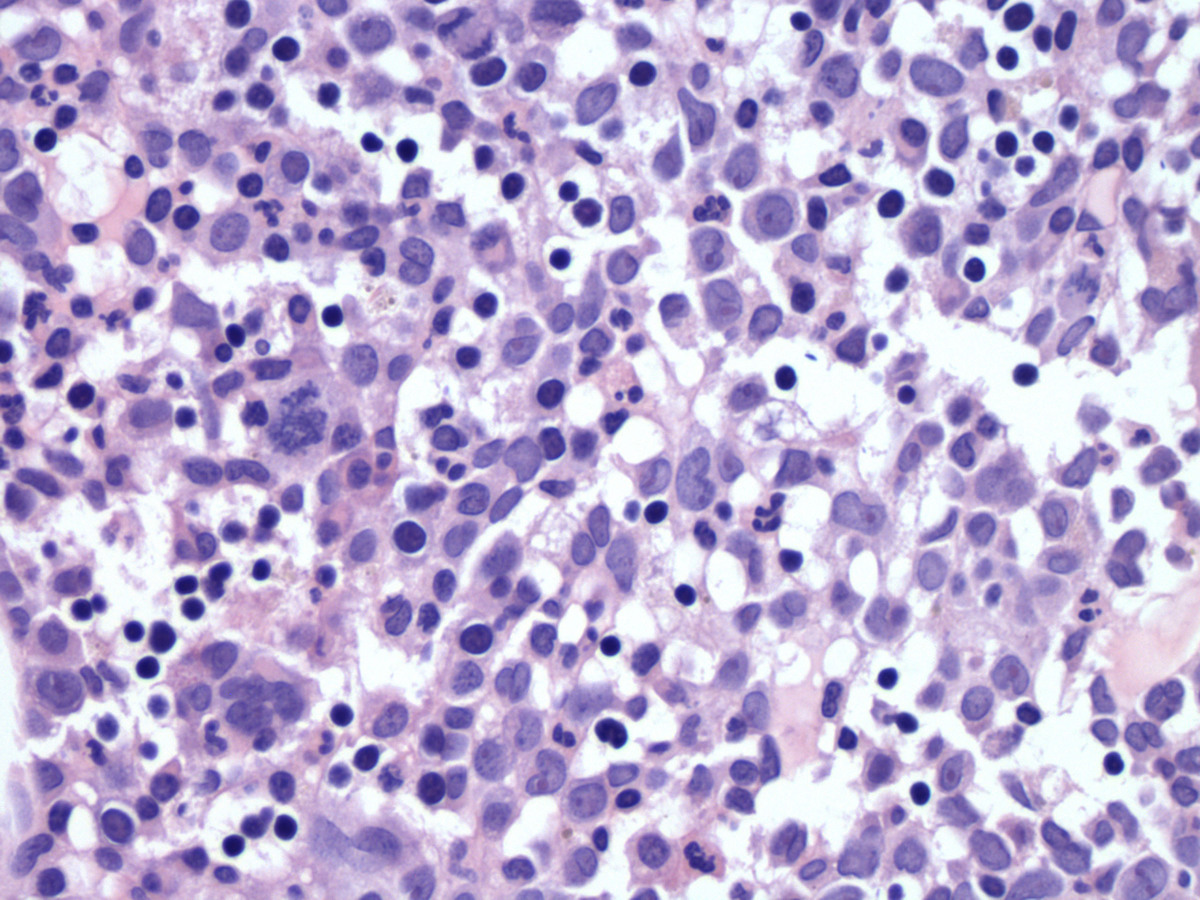 The bone marrow biopsy shows normocellular (30-40%) bone morrow with increased immature cells (H&E, 400x).